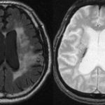 認知症改善に映像を