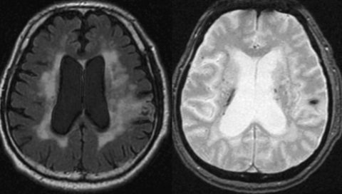 認知症改善に映像を