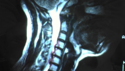 ヘルニア手術×映像